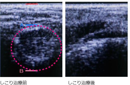 シコリ治療とアフターケア