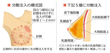 バストへの分散注入の目的