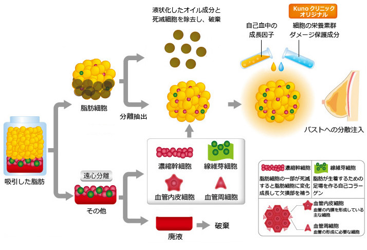 美容外科Kunoクリニックオリジナルシリコンバック抜去&同日高度再生豊胸術