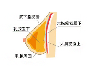 オーダーメイドデザイン注入