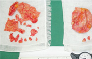 高度石灰化した被膜を摘出（open capsulectomy)
