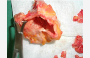 高度石灰化した被膜を摘出（open capsulectomy)
