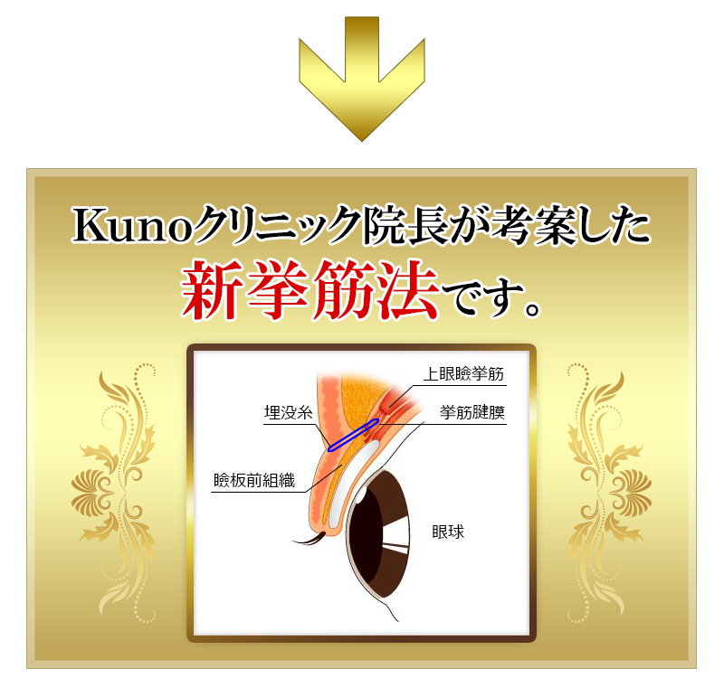 Kunoクリニックオリジナル新挙筋法