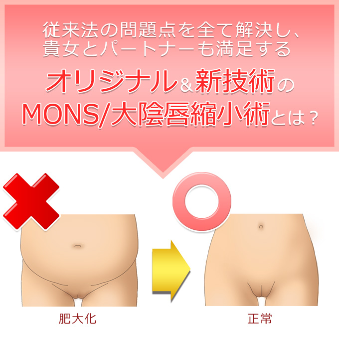 MONS/大陰唇縮小術とは？