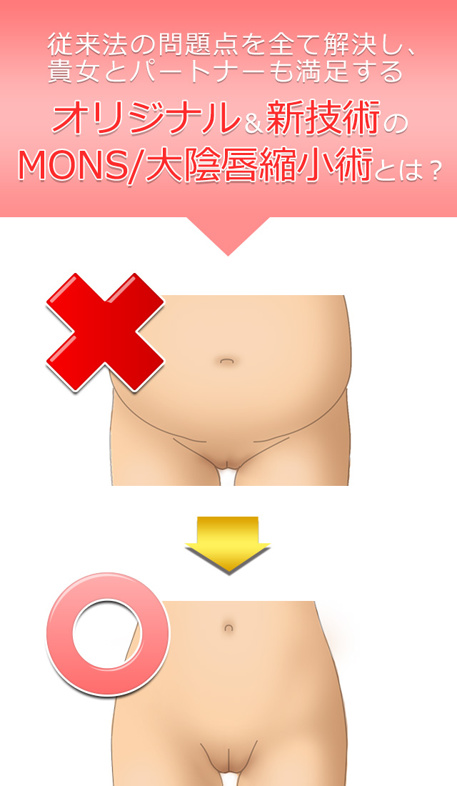 オリジナル&新技術のMONS/大陰唇縮小術