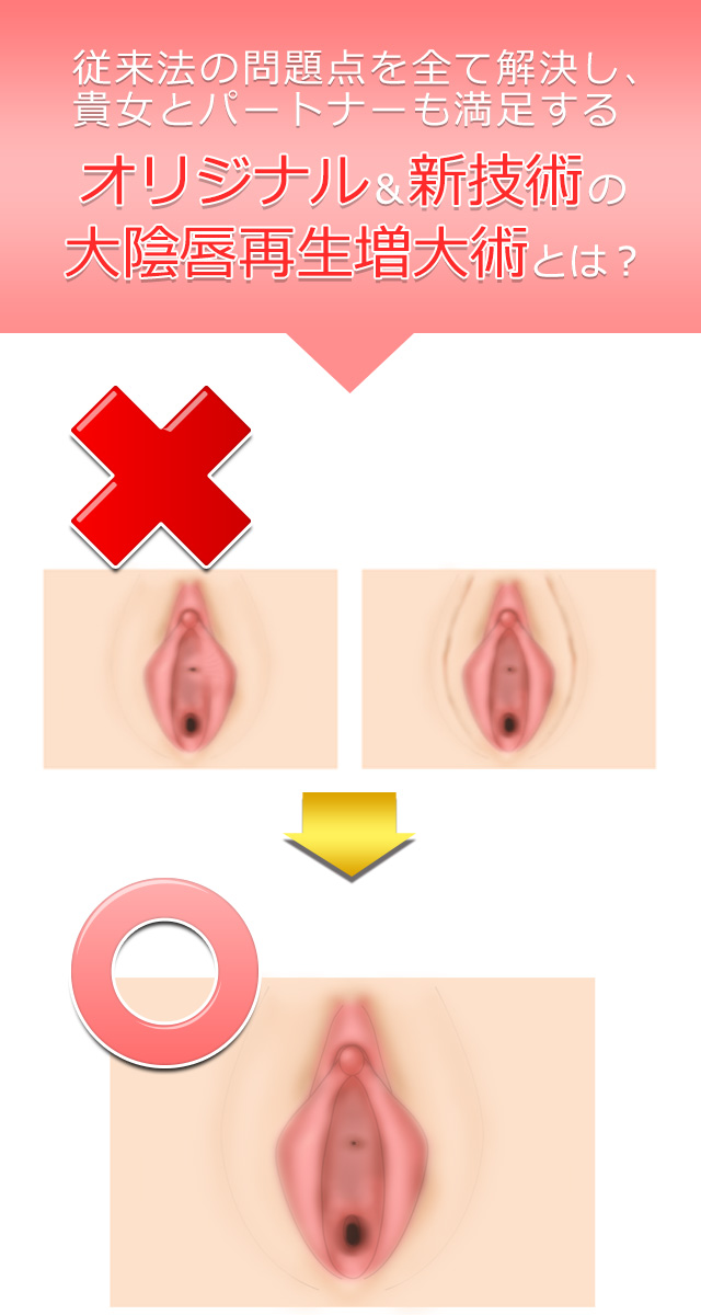 オリジナル&新技術の大陰唇再生増大術