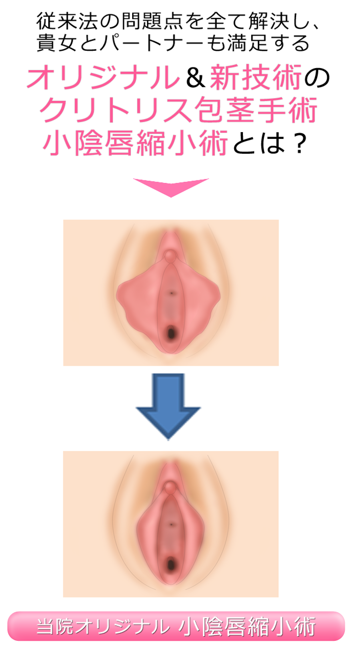 小陰唇縮小術