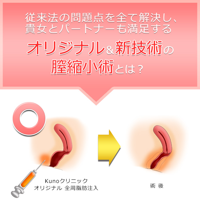 オリジナル&新技術の膣縮小術