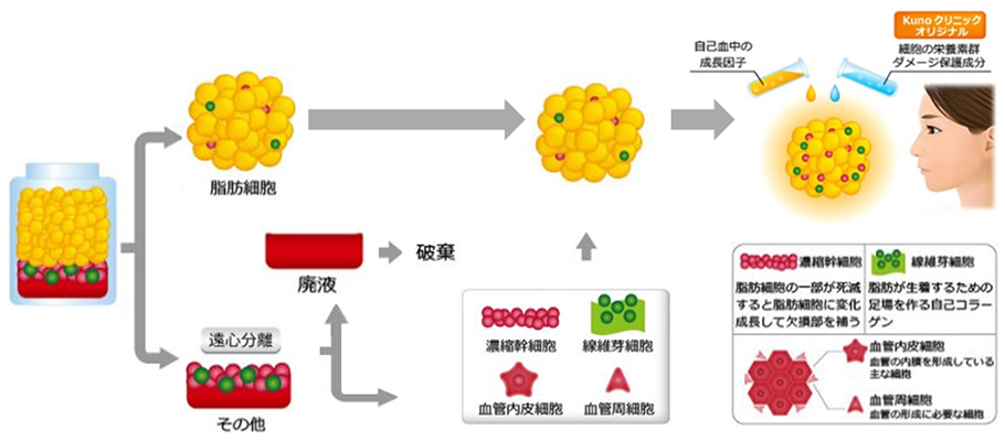 Kunoクリニックオリジナル 脂肪注入・生体内再生医療とは？