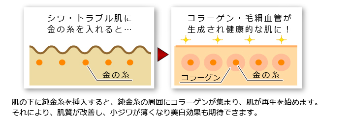 金の糸(Golden filament)挿入美容術とは?