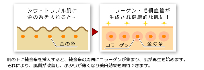 金の糸（Golden filament）挿入美容術とは？