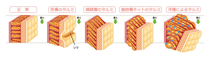 タルミの原因と種類