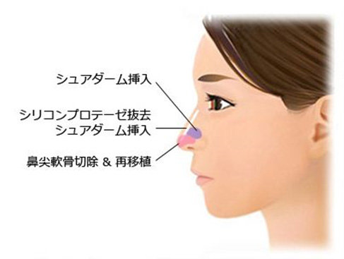 鼻尖軟骨切除再移植&Sure Derm挿入術