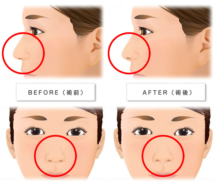 鼻中隔延長術・ブタ鼻の改善