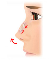 拘縮や上向き鼻（所謂ブタ鼻）の治療と予防①