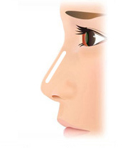 拘縮や上向き鼻（所謂ブタ鼻）の治療と予防②