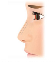 拘縮や上向き鼻（所謂ブタ鼻）の治療と予防③