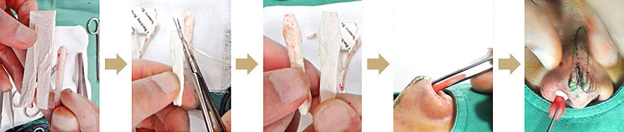 当院のSure Derm挿入・置換術とは