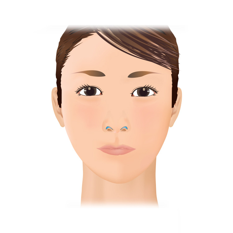 鼻翼形成(鼻孔を下げる手術)