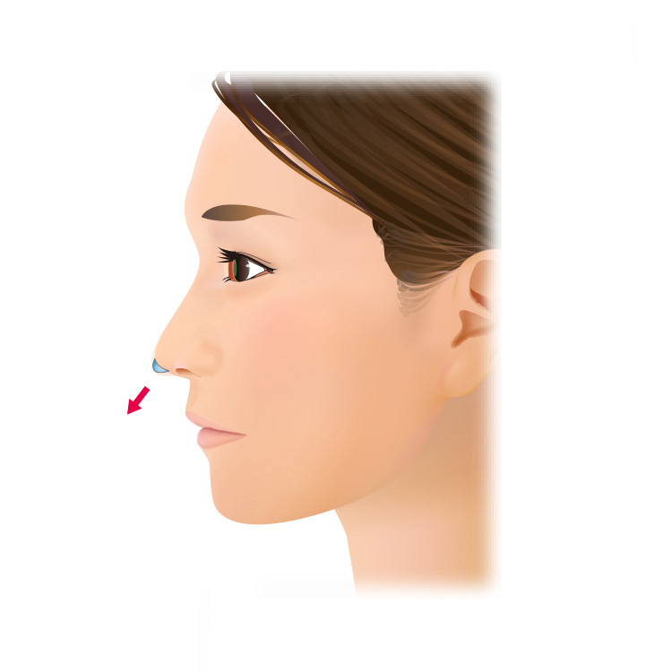 鼻尖部形成（鼻尖を下げる手術）
