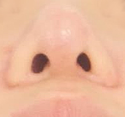 呼吸抑制が生じる・ダンゴ鼻が目立つ小鼻縮小術